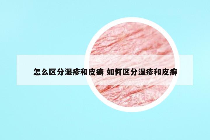 怎么区分湿疹和皮癣 如何区分湿疹和皮癣