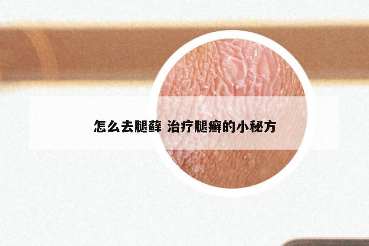 怎么去腿藓 治疗腿癣的小秘方