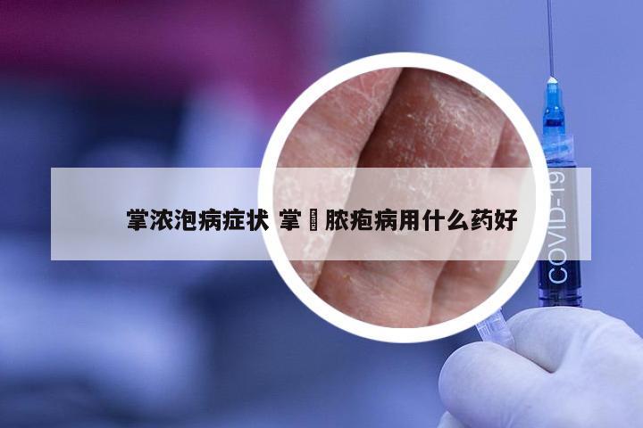 掌浓泡病症状 掌踀脓疱病用什么药好