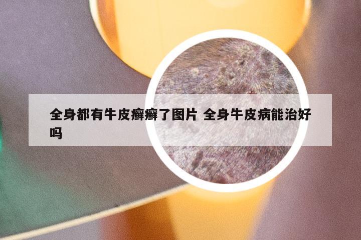 全身都有牛皮癣癣了图片 全身牛皮病能治好吗