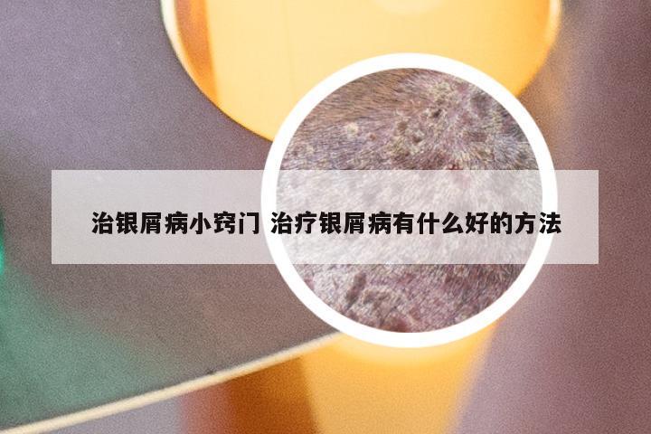 治银屑病小窍门 治疗银屑病有什么好的方法