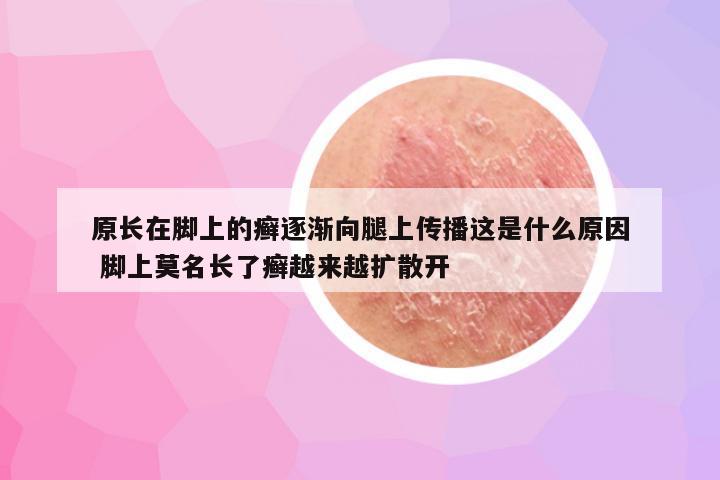 原长在脚上的癣逐渐向腿上传播这是什么原因 脚上莫名长了癣越来越扩散开