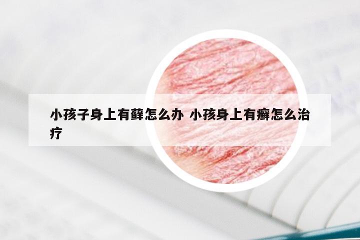 小孩子身上有藓怎么办 小孩身上有癣怎么治疗