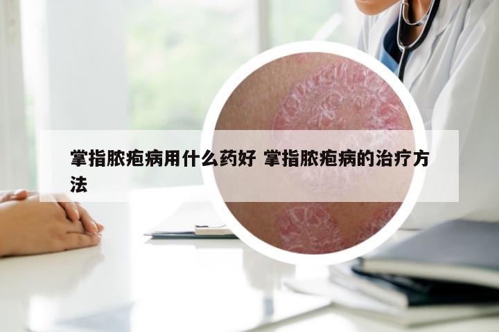 掌指脓疱病用什么药好 掌指脓疱病的治疗方法