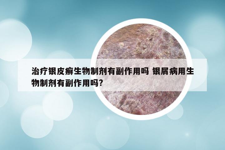 治疗银皮癣生物制剂有副作用吗 银屑病用生物制剂有副作用吗?