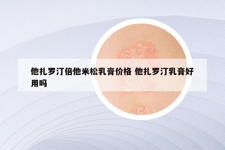 他扎罗汀倍他米松乳膏价格 他扎罗汀乳膏好用吗