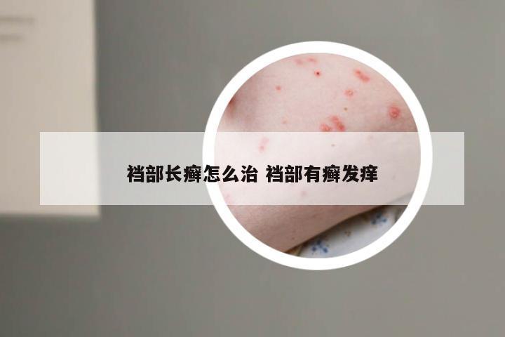 裆部长癣怎么治 裆部有癣发痒