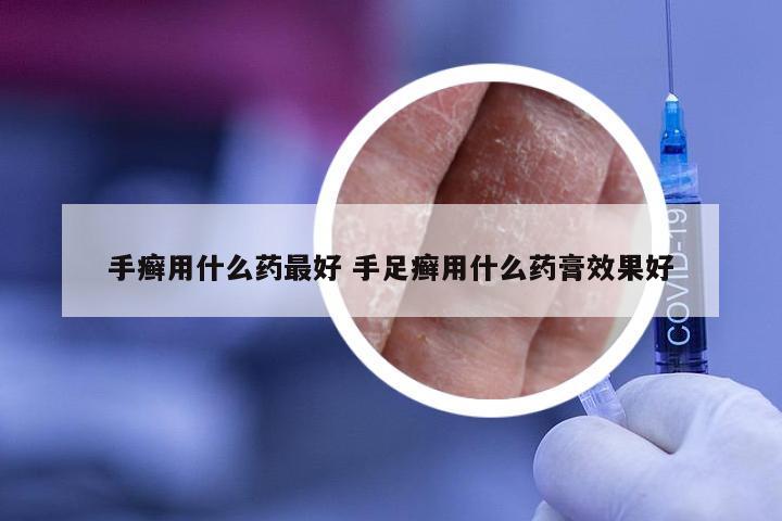 手癣用什么药最好 手足癣用什么药膏效果好