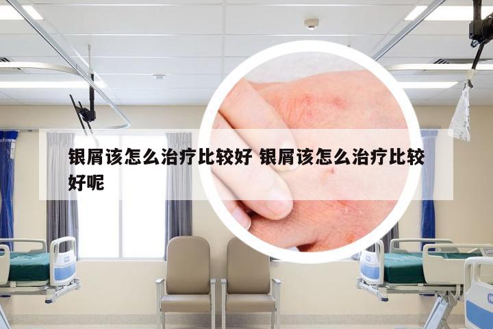 银屑该怎么治疗比较好 银屑该怎么治疗比较好呢