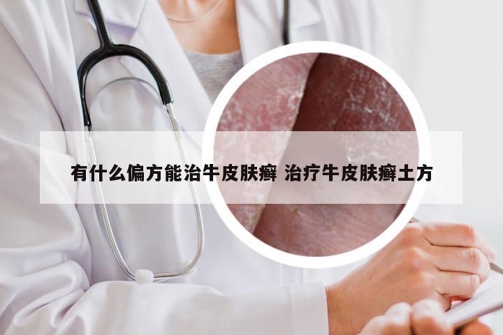 有什么偏方能治牛皮肤癣 治疗牛皮肤癣土方