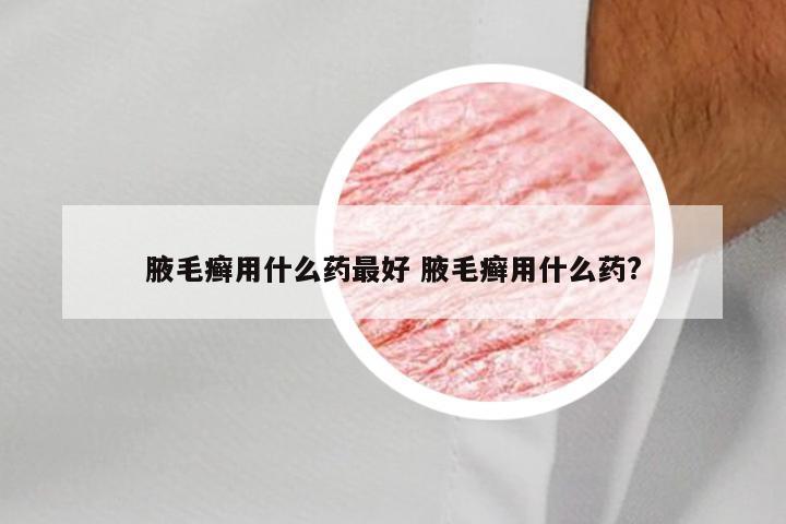 腋毛癣用什么药最好 腋毛癣用什么药?