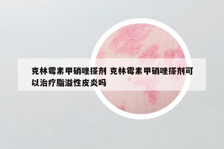 克林霉素甲硝唑搽剂 克林霉素甲硝唑搽剂可以治疗脂溢性皮炎吗