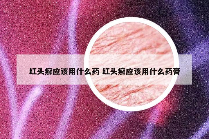 红头癣应该用什么药 红头癣应该用什么药膏