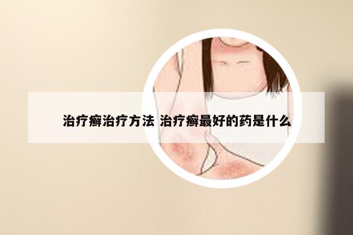 治疗癣治疗方法 治疗癣最好的药是什么