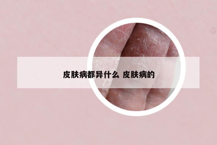 皮肤病都异什么 皮肤病的