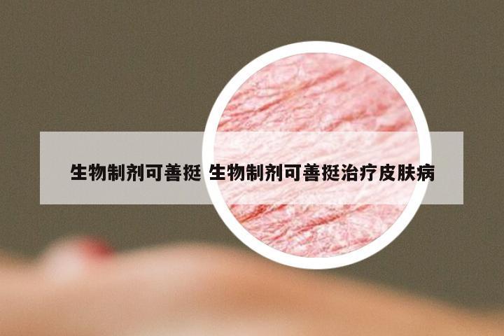 生物制剂可善挺 生物制剂可善挺治疗皮肤病