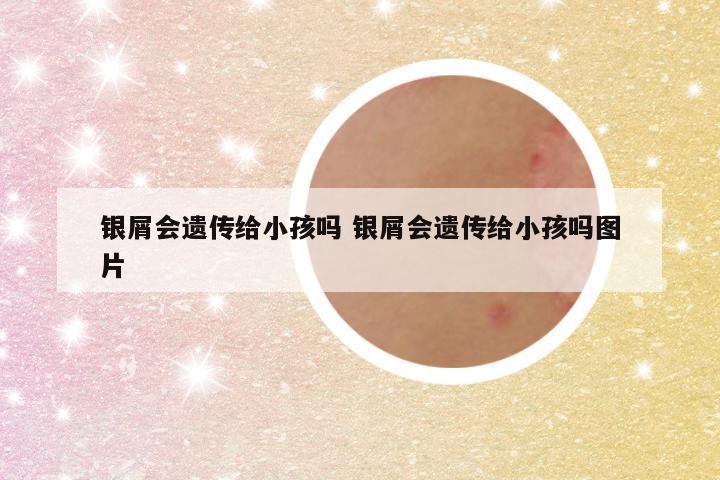 银屑会遗传给小孩吗 银屑会遗传给小孩吗图片