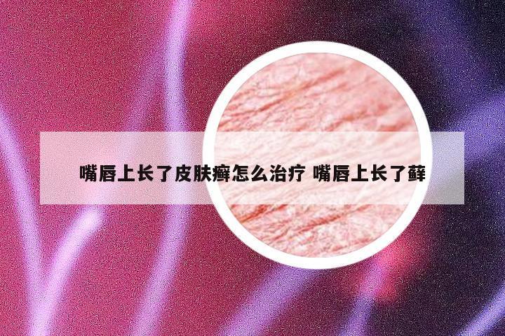 嘴唇上长了皮肤癣怎么治疗 嘴唇上长了藓