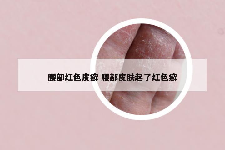 腰部红色皮癣 腰部皮肤起了红色癣