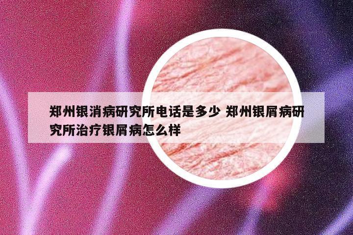 郑州银消病研究所电话是多少 郑州银屑病研究所治疗银屑病怎么样