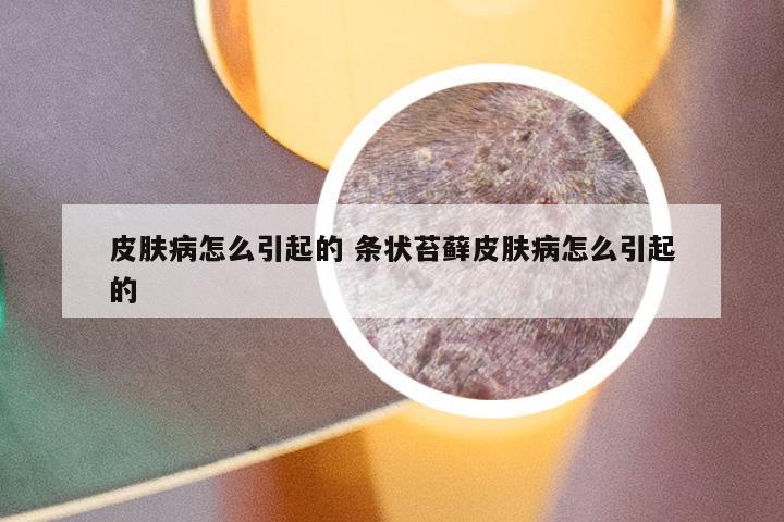 皮肤病怎么引起的 条状苔藓皮肤病怎么引起的