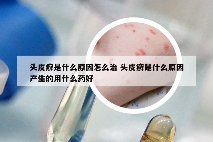 头皮癣是什么原因怎么治 头皮癣是什么原因产生的用什么药好