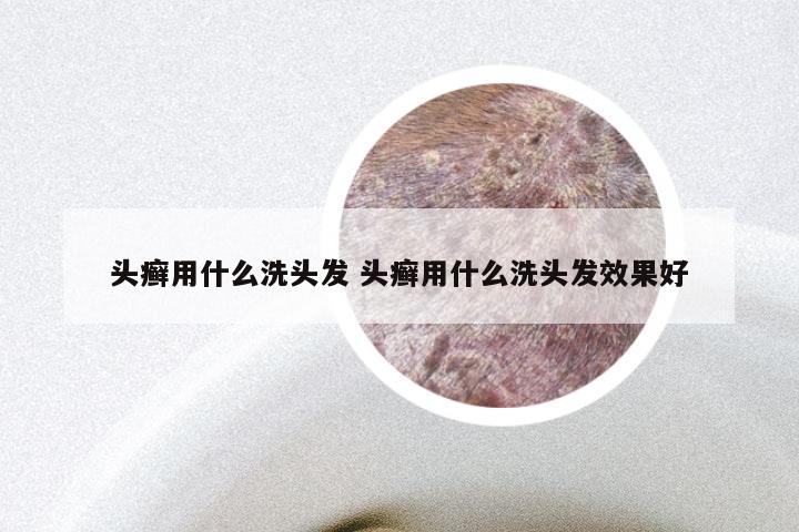 头癣用什么洗头发 头癣用什么洗头发效果好