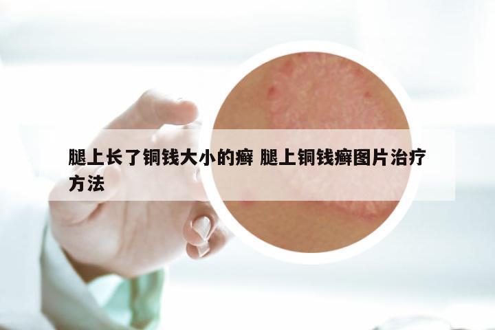 腿上长了铜钱大小的癣 腿上铜钱癣图片治疗方法