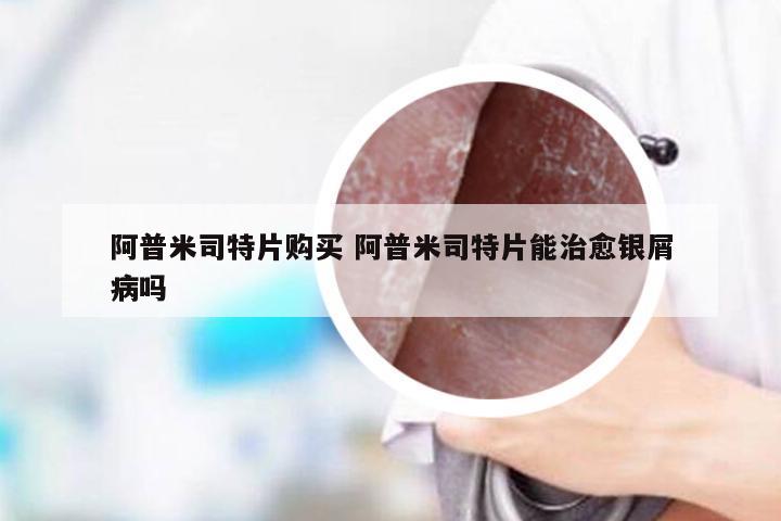 阿普米司特片购买 阿普米司特片能治愈银屑病吗