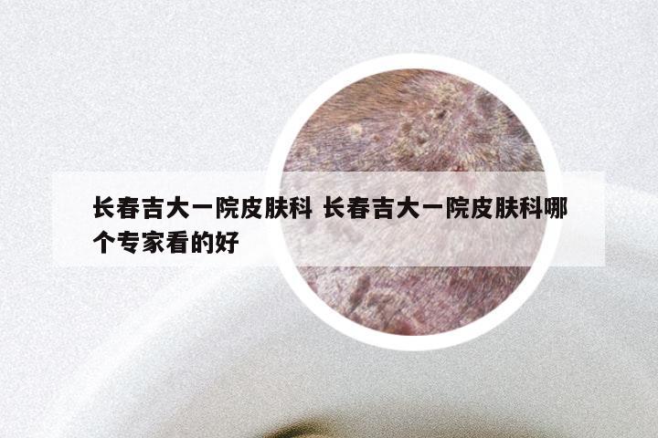 长春吉大一院皮肤科 长春吉大一院皮肤科哪个专家看的好