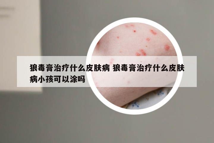 狼毒膏治疗什么皮肤病 狼毒膏治疗什么皮肤病小孩可以涂吗