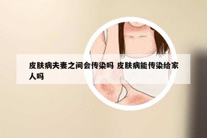 皮肤病夫妻之间会传染吗 皮肤病能传染给家人吗