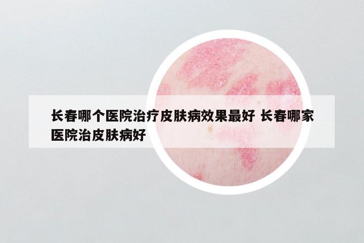 长春哪个医院治疗皮肤病效果最好 长春哪家医院治皮肤病好