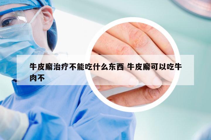 牛皮廨治疗不能吃什么东西 牛皮廨可以吃牛肉不