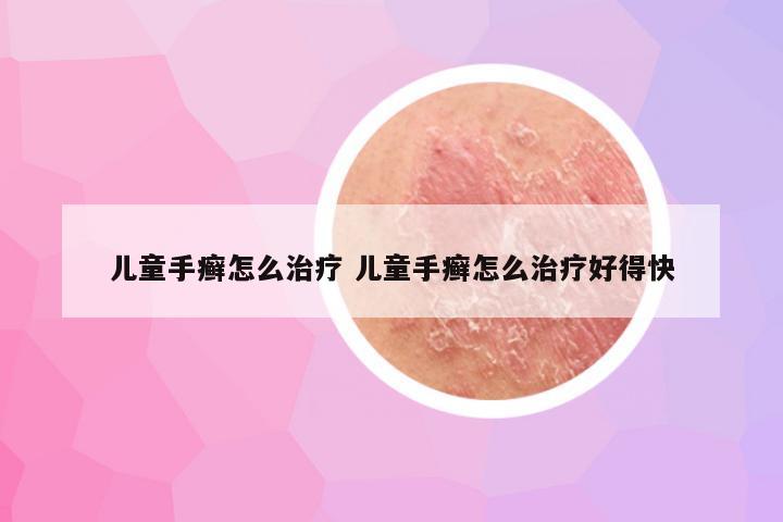 儿童手癣怎么治疗 儿童手癣怎么治疗好得快