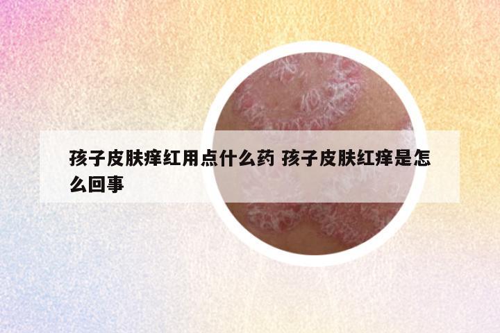 孩子皮肤痒红用点什么药 孩子皮肤红痒是怎么回事