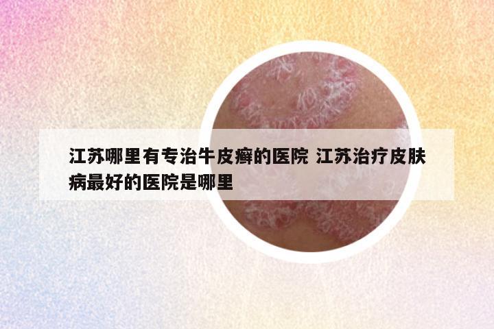 江苏哪里有专治牛皮癣的医院 江苏治疗皮肤病最好的医院是哪里