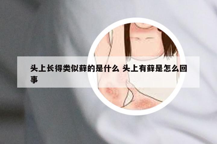 头上长得类似藓的是什么 头上有藓是怎么回事