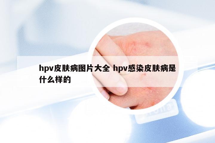 hpv皮肤病图片大全 hpv感染皮肤病是什么样的