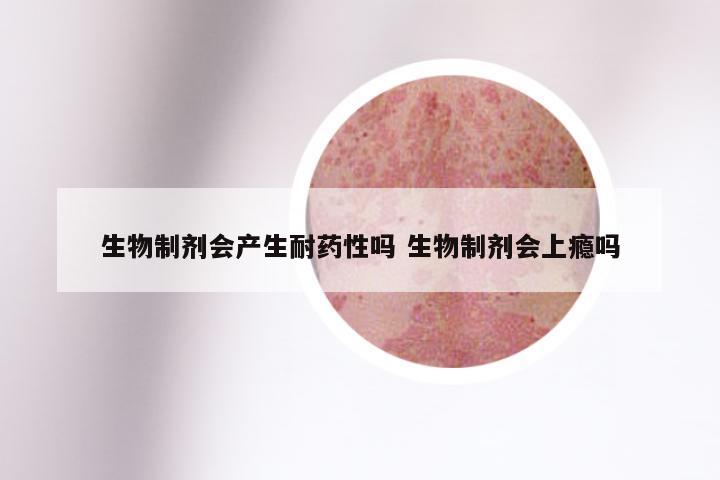 生物制剂会产生耐药性吗 生物制剂会上瘾吗