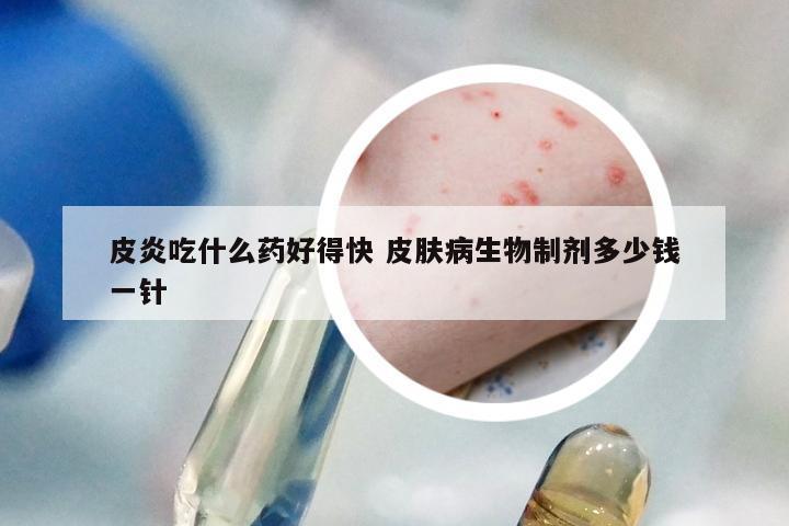 皮炎吃什么药好得快 皮肤病生物制剂多少钱一针