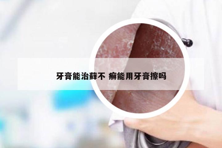 牙膏能治藓不 癣能用牙膏擦吗