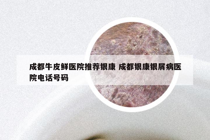 成都牛皮鲜医院推荐银康 成都银康银屑病医院电话号码