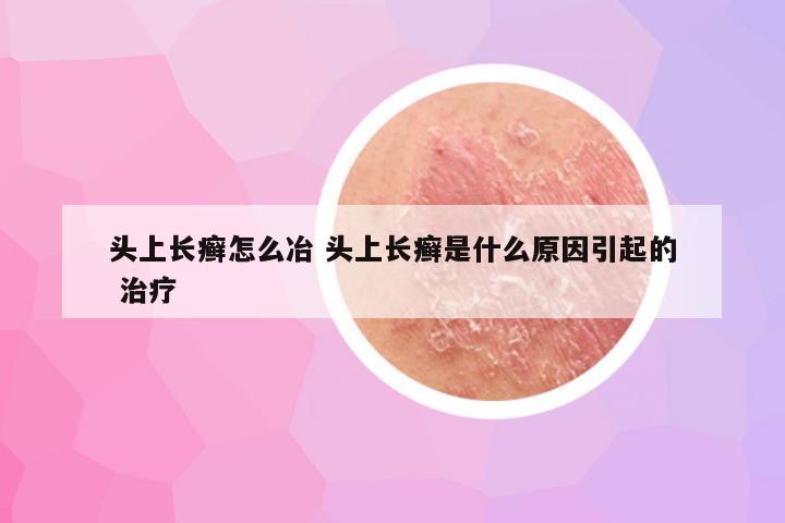 头上长癣怎么冶 头上长癣是什么原因引起的 治疗