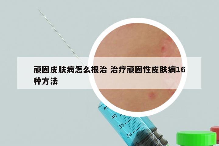 顽固皮肤病怎么根治 治疗顽固性皮肤病16种方法