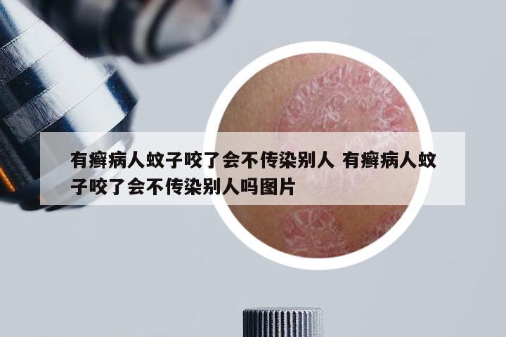 有癣病人蚊子咬了会不传染别人 有癣病人蚊子咬了会不传染别人吗图片