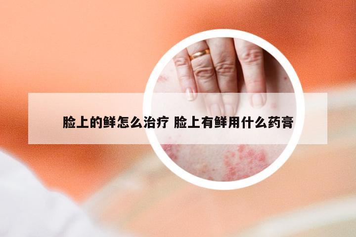 脸上的鲜怎么治疗 脸上有鲜用什么药膏