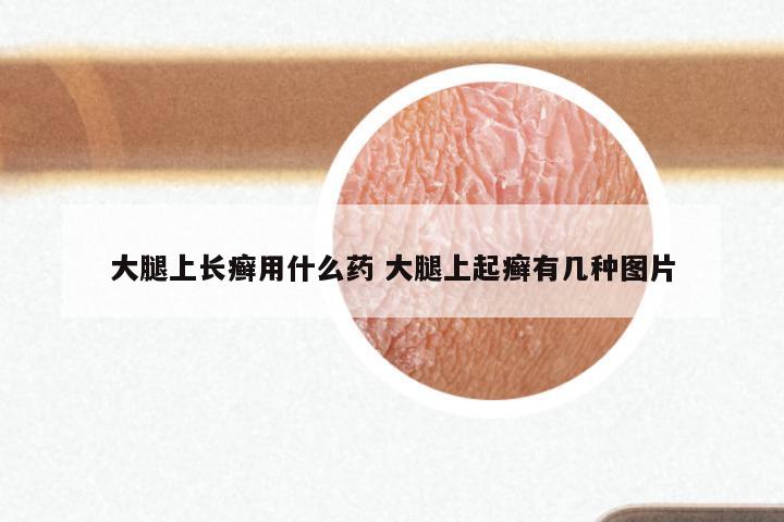 大腿上长癣用什么药 大腿上起癣有几种图片