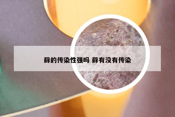 藓的传染性强吗 藓有没有传染