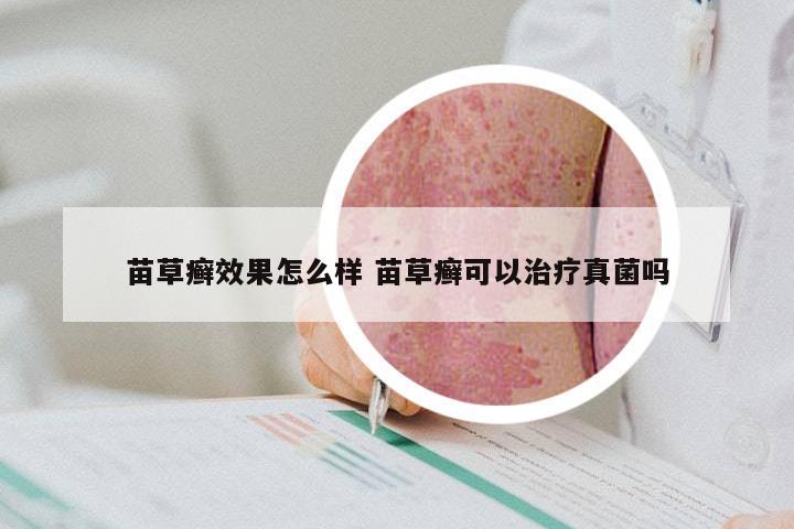 苗草癣效果怎么样 苗草癣可以治疗真菌吗